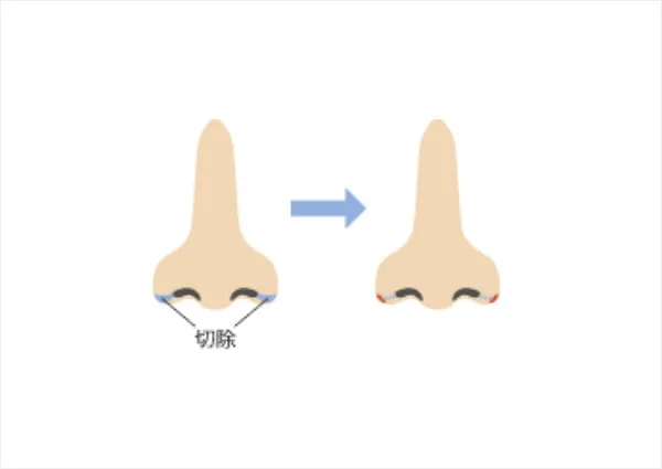 鼻翼縮小術とは