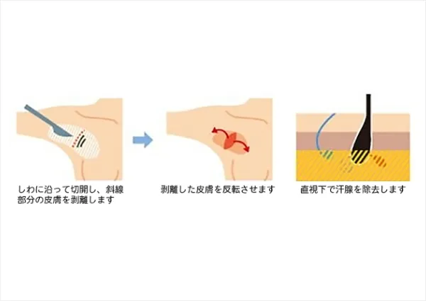 剪除法（切開法）
