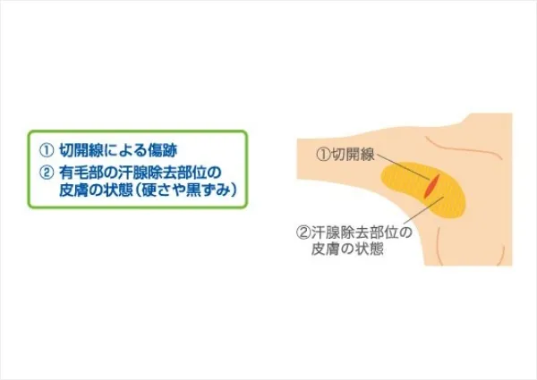 手術後の傷跡について