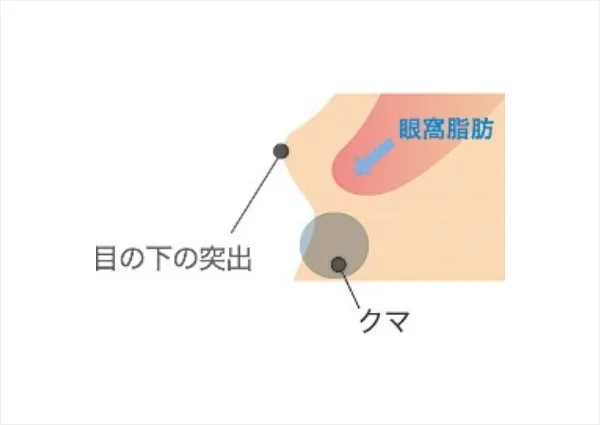 クマの原因