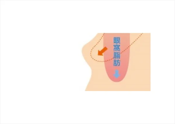眼窩脂肪の方向を変更
