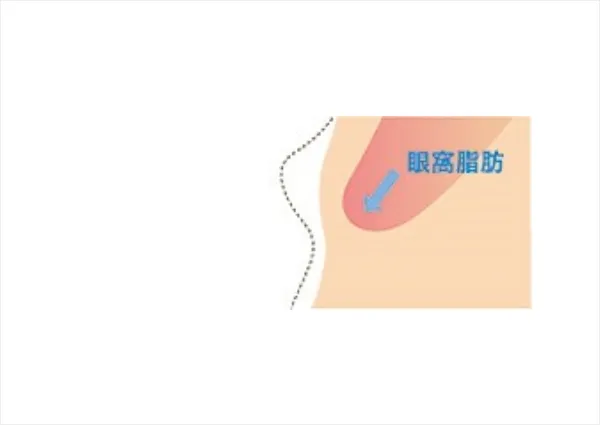皮膚・眼輪筋の切除