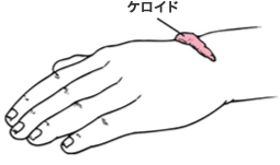 ケロイド