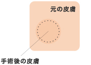 元の皮膚 手術後の皮膚