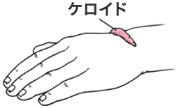 ケロイド